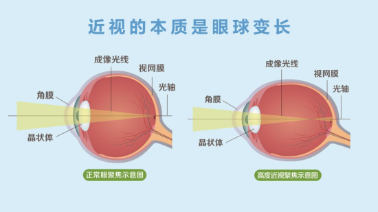 远视的力专素量是眼球变少。重庆爱我女童眼科医院供图